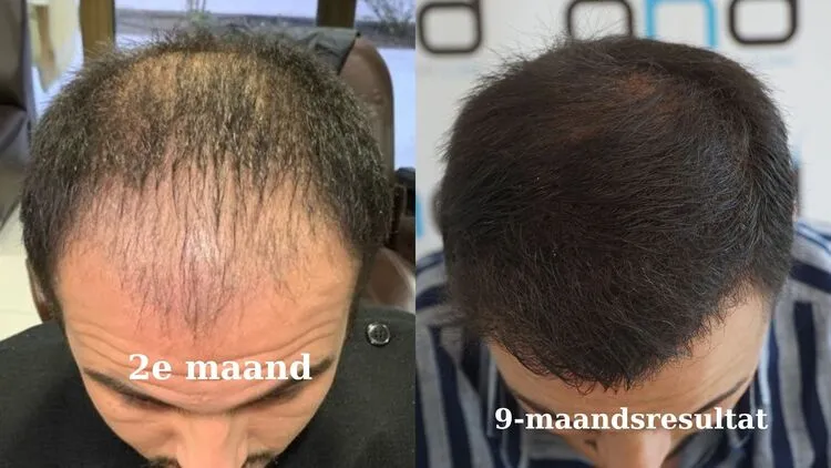 Hier is een foto die het resultaat van een haartransplantatie na 2 maanden en 10 maanden laat zien.