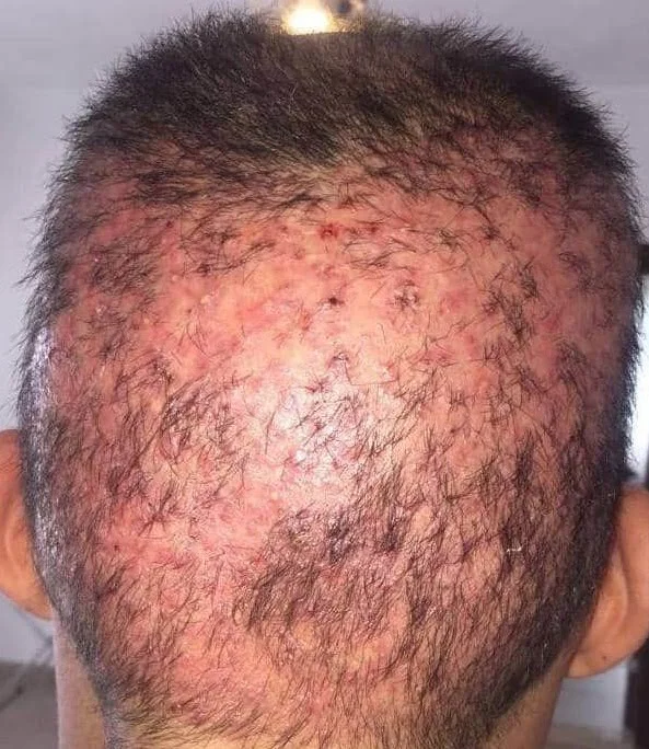 Perte de cheveux permanente et aspect inesthétique dus à une mauvaise collecte de greffons.