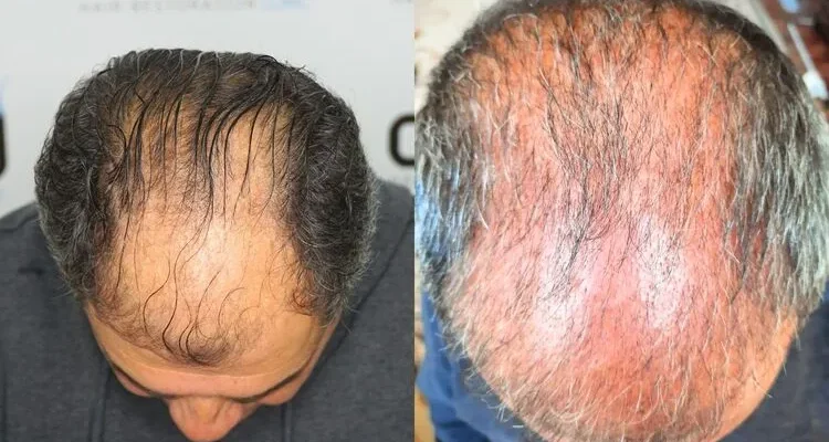 Shock loss for 3 months