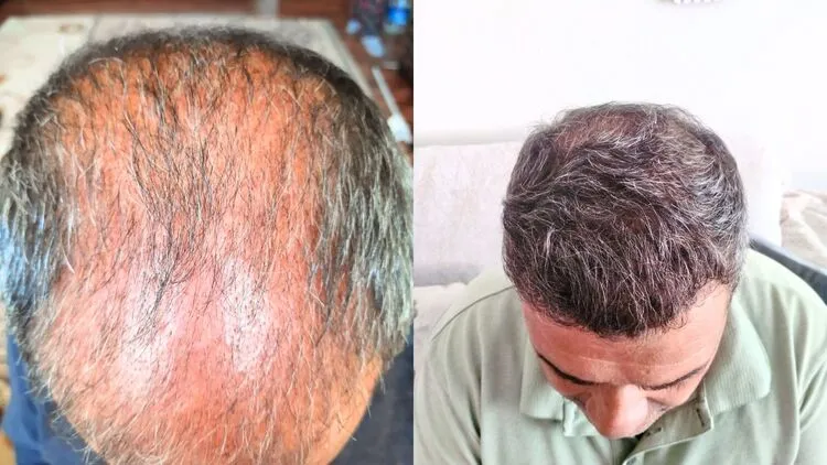 Das 3-Monats-Erscheinungsbild mit Schockhaarausfall und das 1-Jahres-Ergebnis (3 aylık şok dökülme görünümü ve 1 yıl sonrası sonuç)