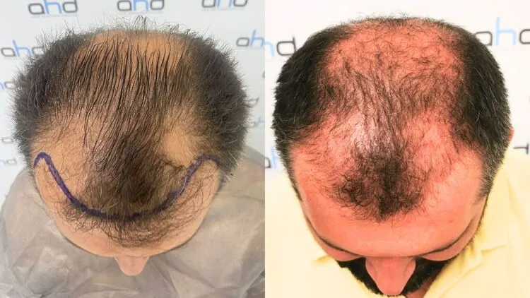 Das Vorher-Bild und das 3-Monats-Foto eines Mannes mit Schockhaarausfall.
