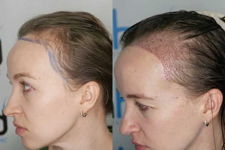 L'attaccatura dei capelli della donna è composta interamente da singoli follicoli piliferi