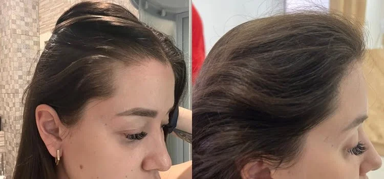 Un'immagine naturale che mostra il prima e il dopo di un trapianto di capelli alle tempie di una donna.