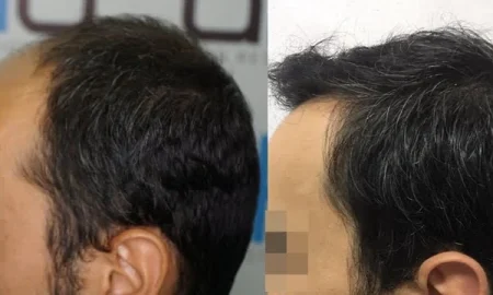 greffe de cheveux tempes