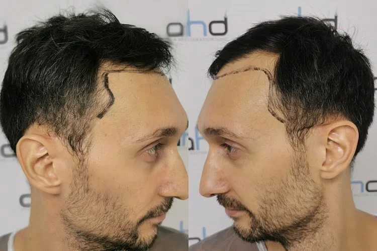 hair transplant temple area