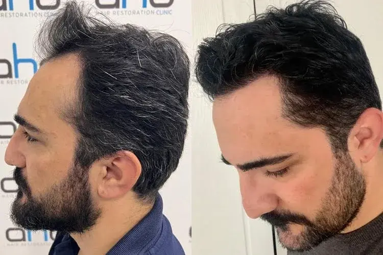 Risultato del trapianto di capelli temporale visto dal lato destro