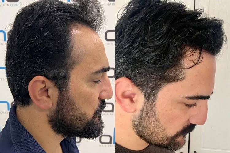 The result of a 2500-graft hair transplant to the frontal hairline and temple region.