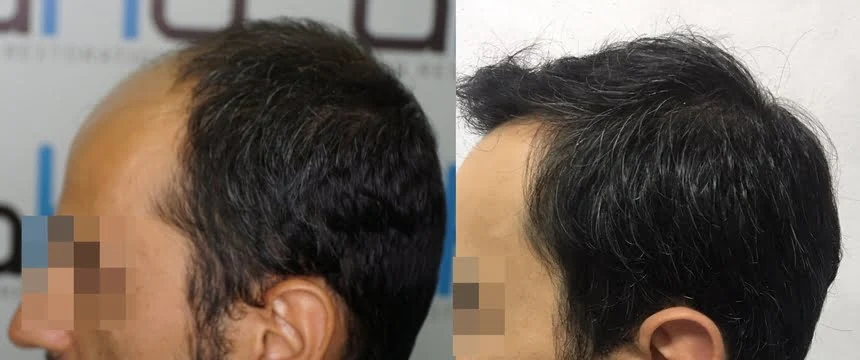 hair transplant temple