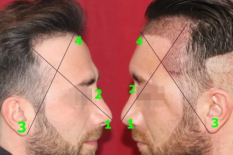 Temple hairline and temporal triangle