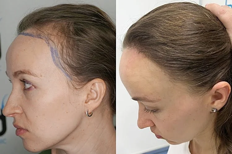 The result of a hair transplant performed on the frontal hairline and temple area in women