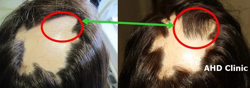 alpeacia areata tanısı konuş bir kadına yapılan saç ekimi