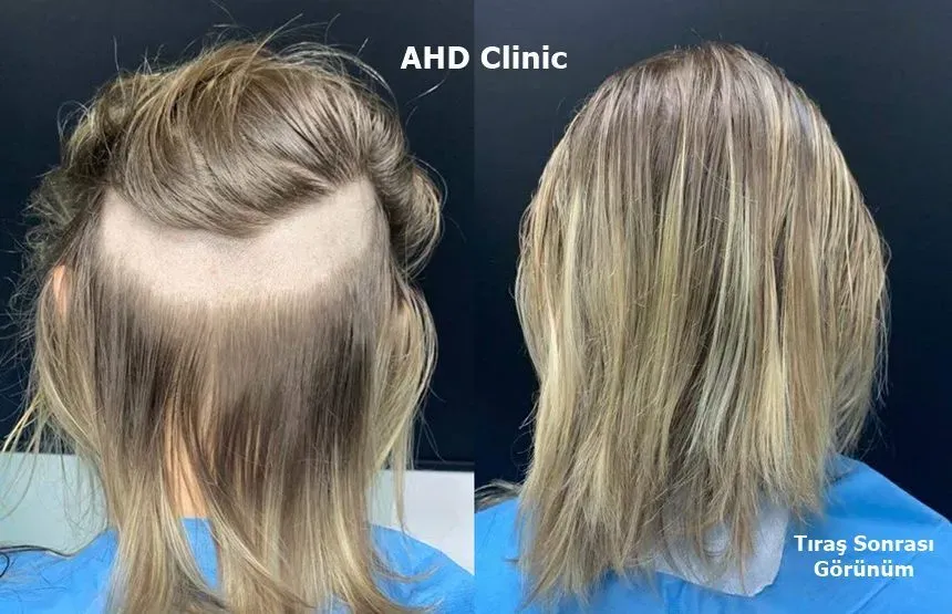 kadın saç ekiminde tıraşsız yöntem