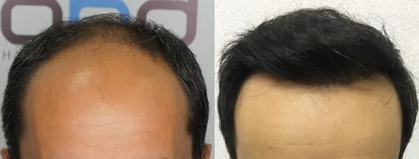 Hair transplant and after 9 months