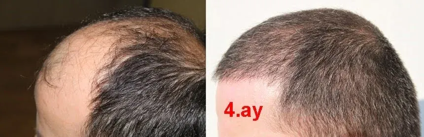 4-month hair transplant result