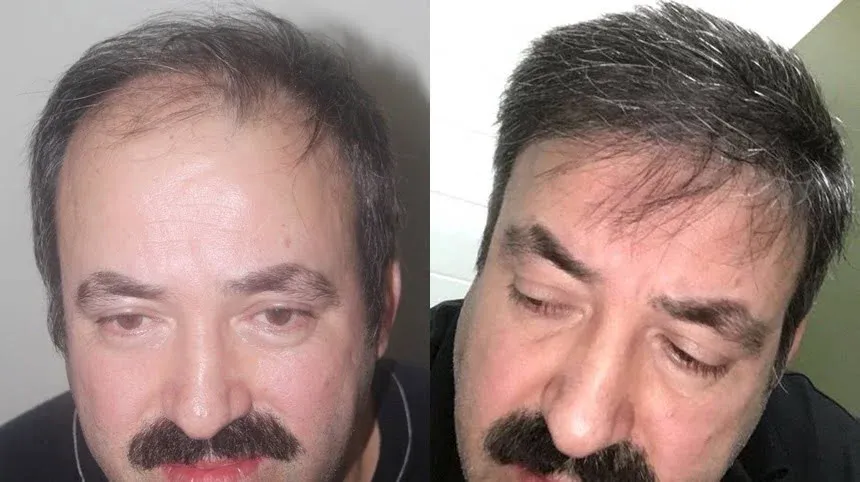 An excellent result in a Norwood Type 6 case with a 9,000-graft hair transplant